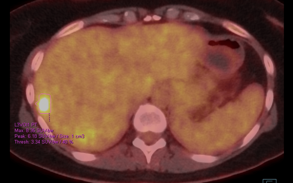 Screenshot of PET scan showing a 1cm bright spot on the liver